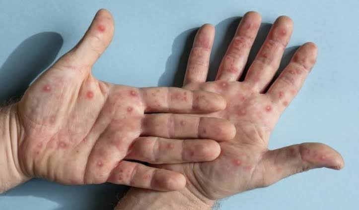 Meski Belum Ada Kasus di Pekanbaru, Dinkes Antisipasi Wabah Monkeypox