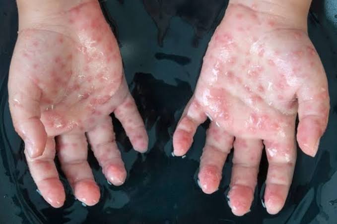 Belum Terdeteksi di Riau, Dinkes Sarankan ini untuk Terhindar dari Virus Mpox