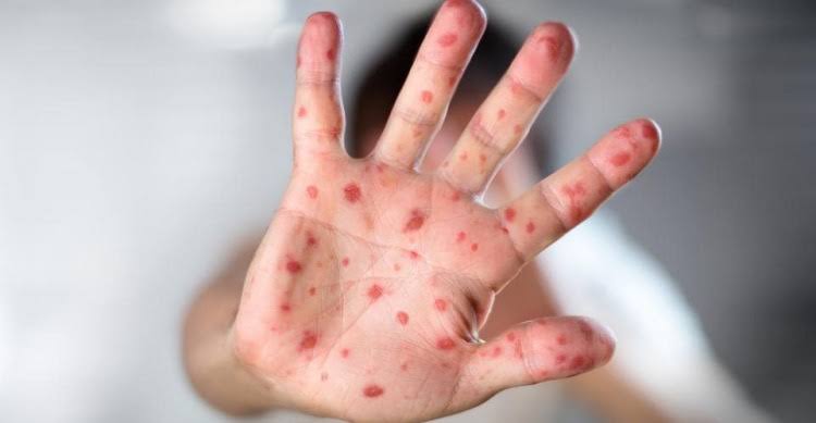 Turki Bersiap Hadapi Penyebaran Virus Monkeypox